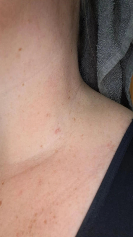 Zip Tag Kit: No More Skin Tags