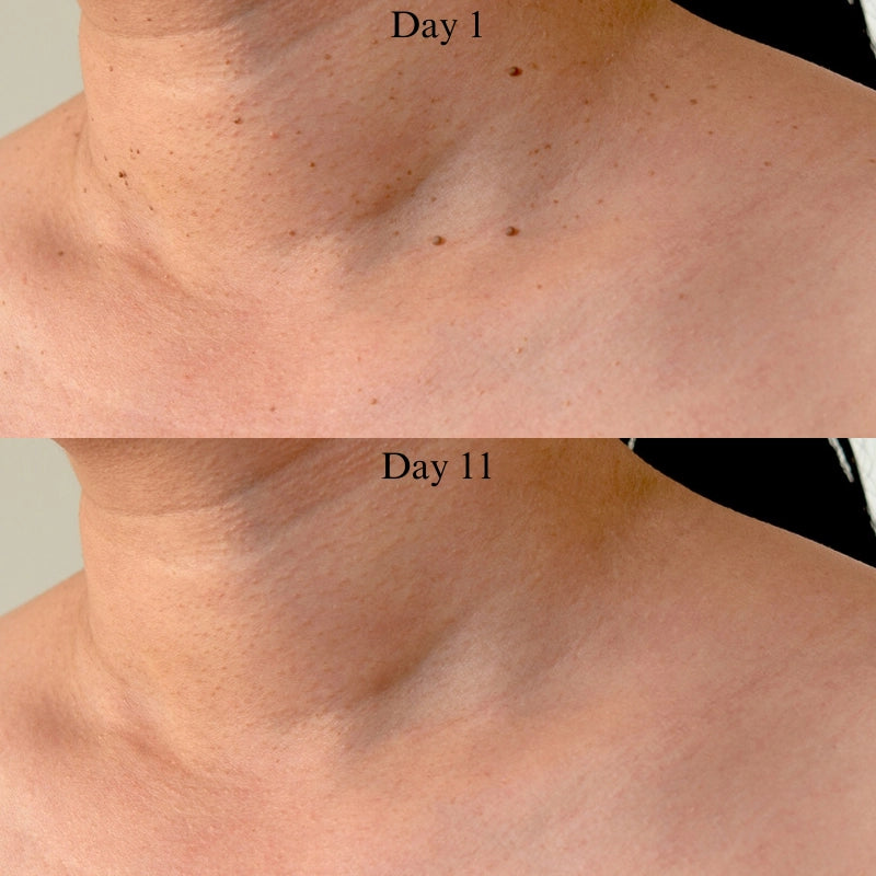 Zip Tag Kit: No More Skin Tags