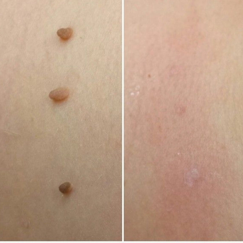Zip Tag Kit: No More Skin Tags