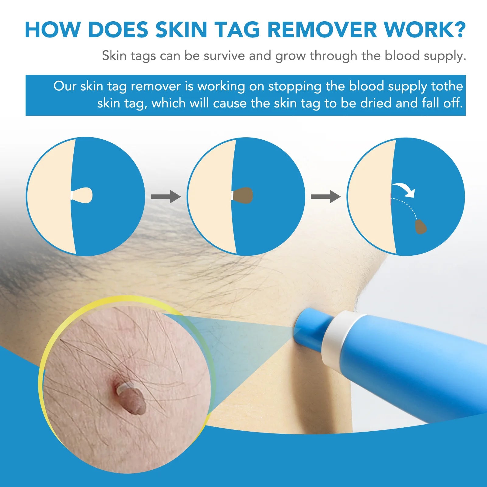 Zip Tag Kit: No More Skin Tags