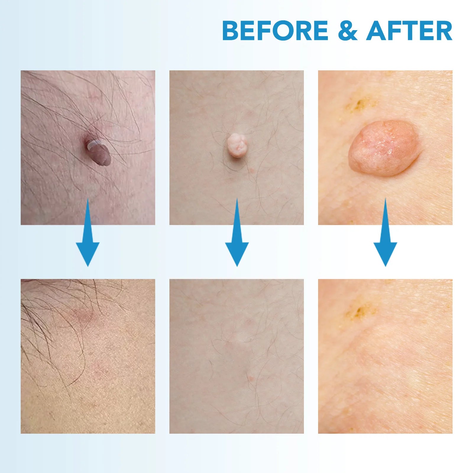 Zip Tag Kit: No More Skin Tags
