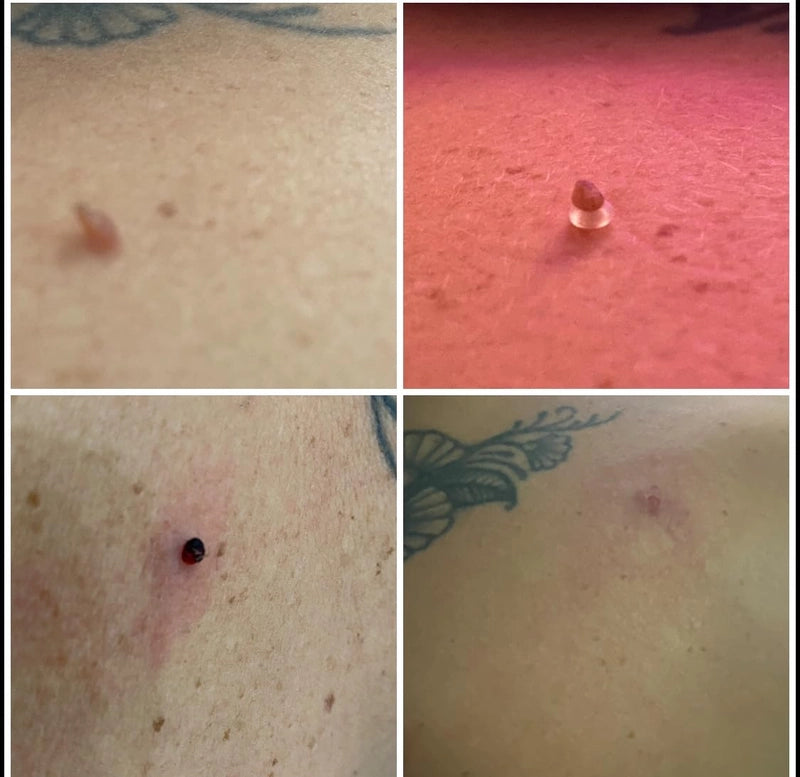 Zip Tag Kit: No More Skin Tags