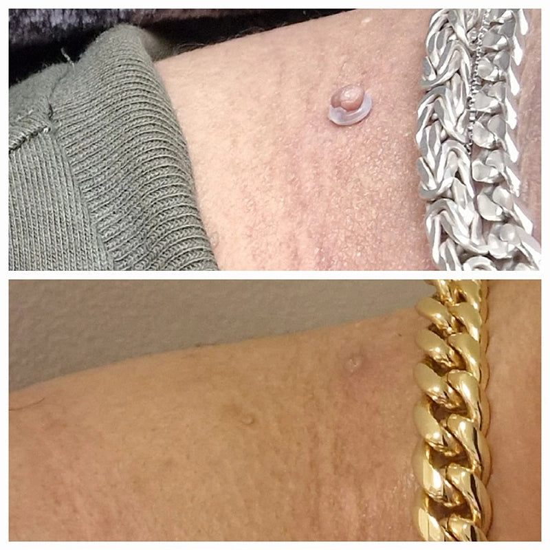 Zip Tag Kit: No More Skin Tags