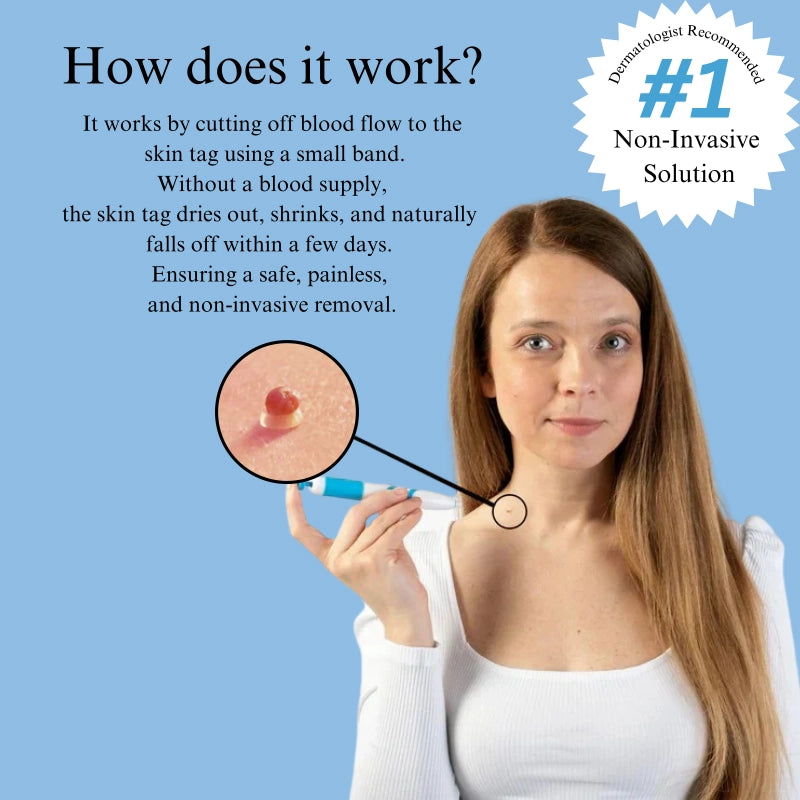 Zip Tag Kit: No More Skin Tags